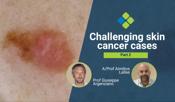challenging skin cancer cases