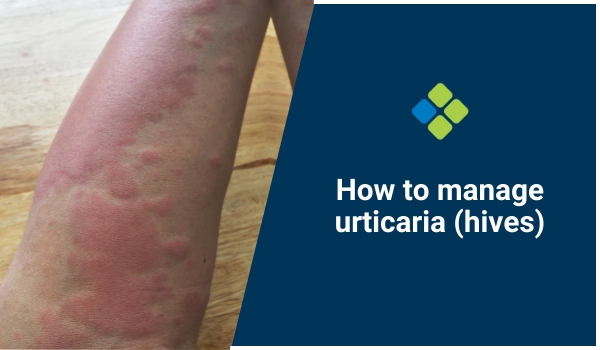 urticaria