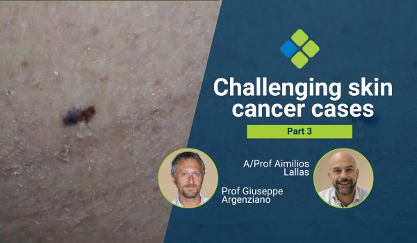 challenging skin cancer cases