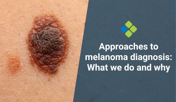 melanoma diagnosis