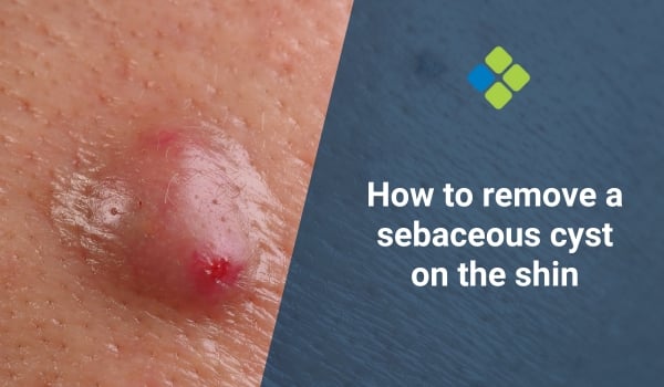 sebaceous cyst