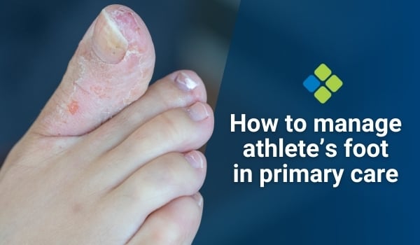 athlete's foot