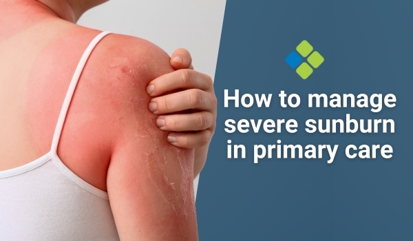 severe sunburn