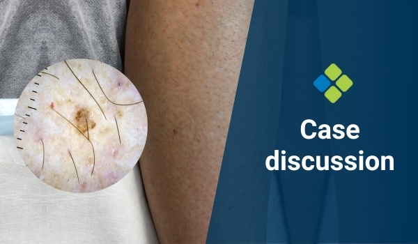 CASE DISCUSSION