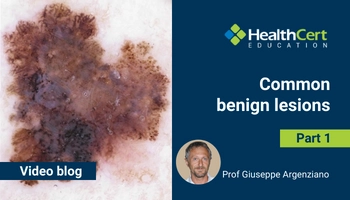 Common benign lesions by Prof Giuseppe Argenziano