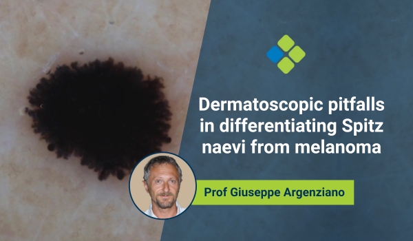 spitz naevi and melanoma