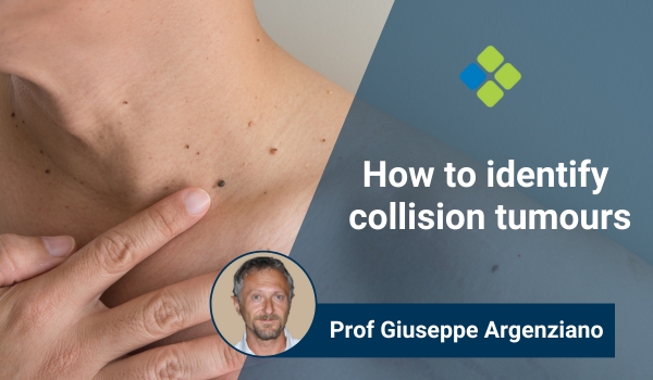 collision tumours