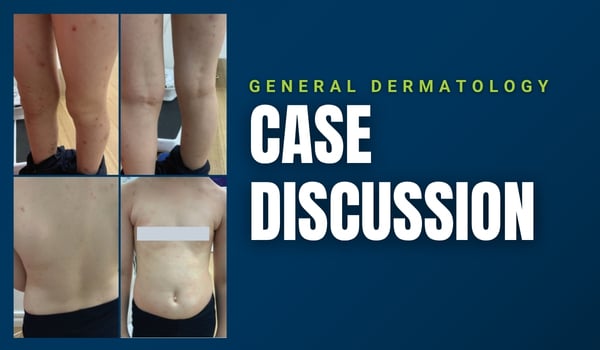 eczema case discussion