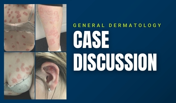 psoriasis case discussion