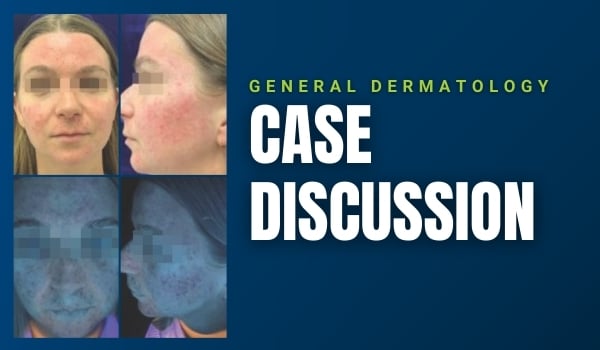rosacea case discussion