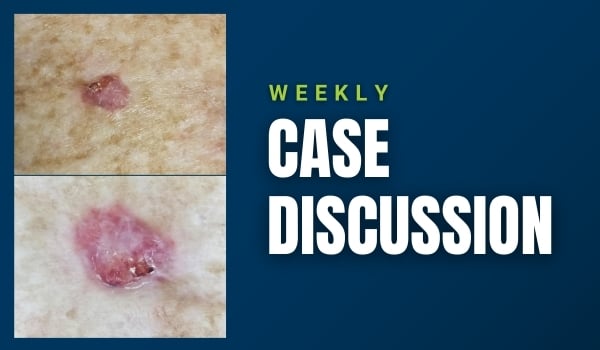 skin cancer case discussion