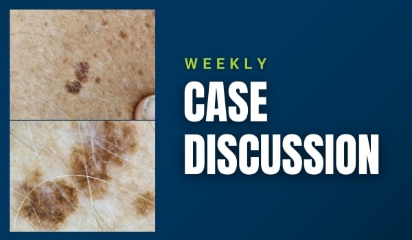 skin cancer case discussion