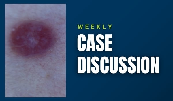 skin cancer case discussion