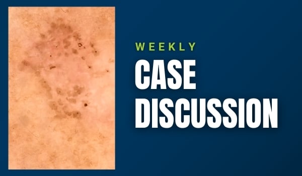 skin cancer case discussion