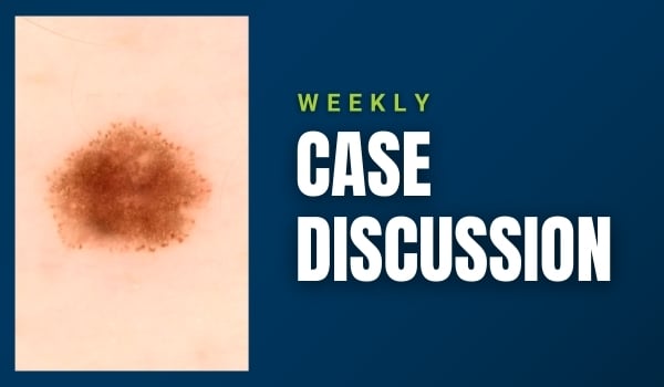 skin cancer case discussion