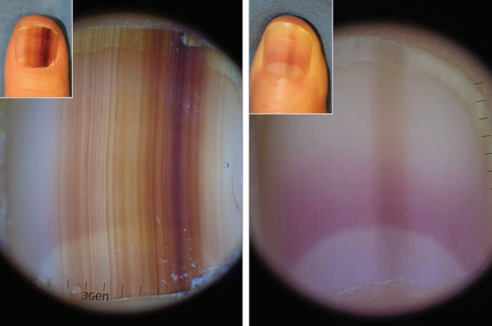 Most dark nail streaks are benign…but not all of them #Nail #Streak # Melanoma #Trauma #Dr #Cancer - YouTube