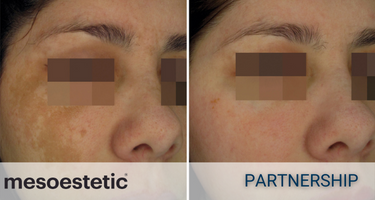 Mesoestetic Mesoestetic