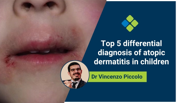 dermatitis in children