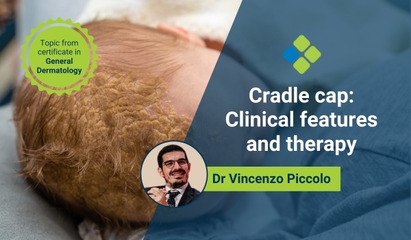 cradle cap