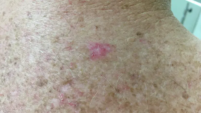 An approach to non-pigmented skin lesions