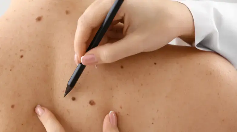 An approach to pigmented skin lesions (Nurses)