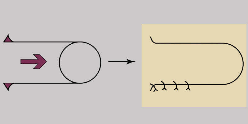 Advancement Flaps 1