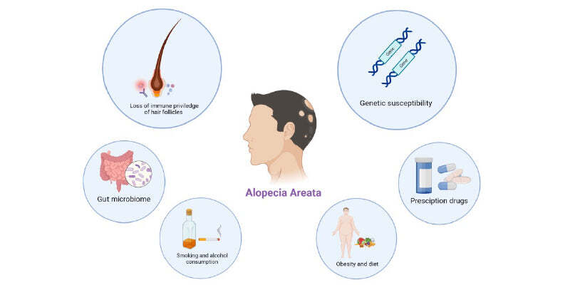 Alopecia Areata - Diagnosis and treatment