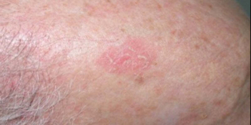 An approach to non-pigmented skin lesions