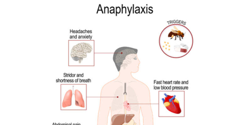 Anaphylaxis – causes, symptoms, emergency treatment
