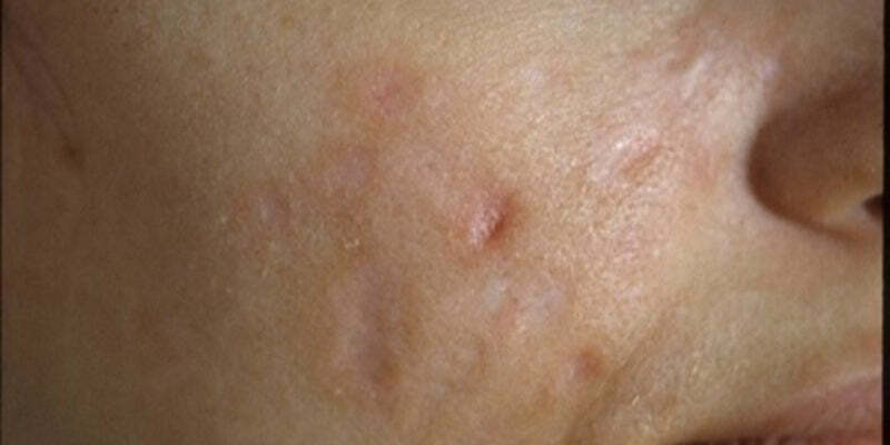 Atopic dermatitis and Acne 1