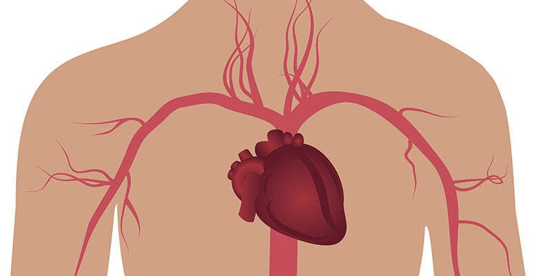 Coronary Artery Disease