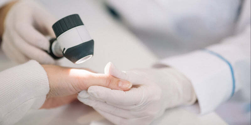Dermoscopy for acral lesions