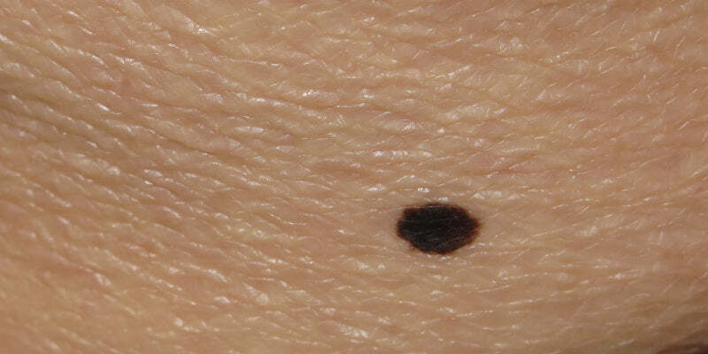 Dermoscopy for difficult benign lesions including naevi with special features