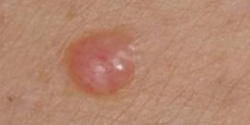 Dermoscopy for difficult melanomas (Nurses)