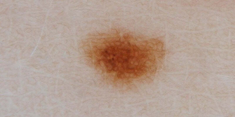 Dermoscopy for melanocytic naevi (Nurses)