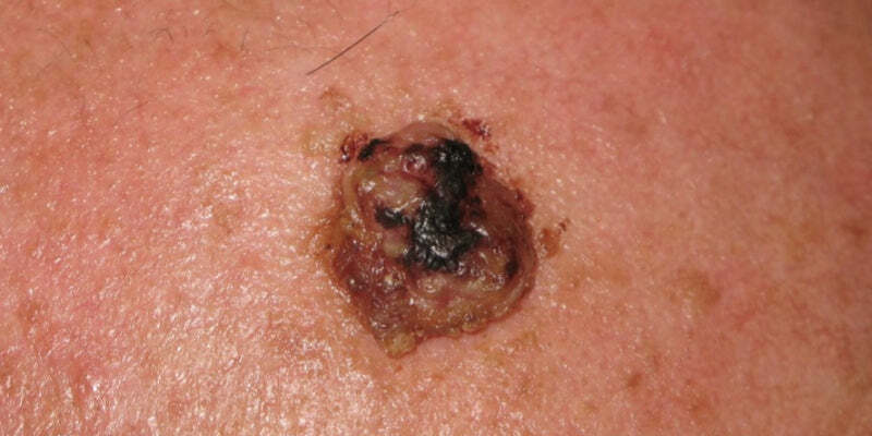 Dermoscopy for rare skin tumours (Nurses)