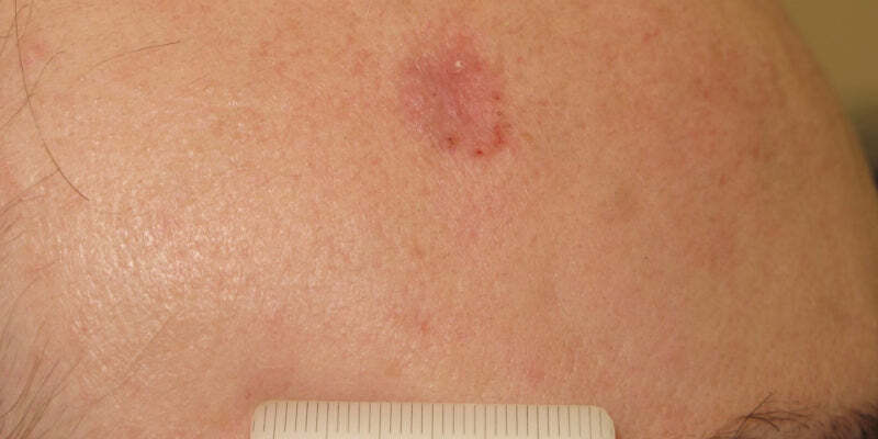 Dermoscopy for the management of non-melanoma skin cancer