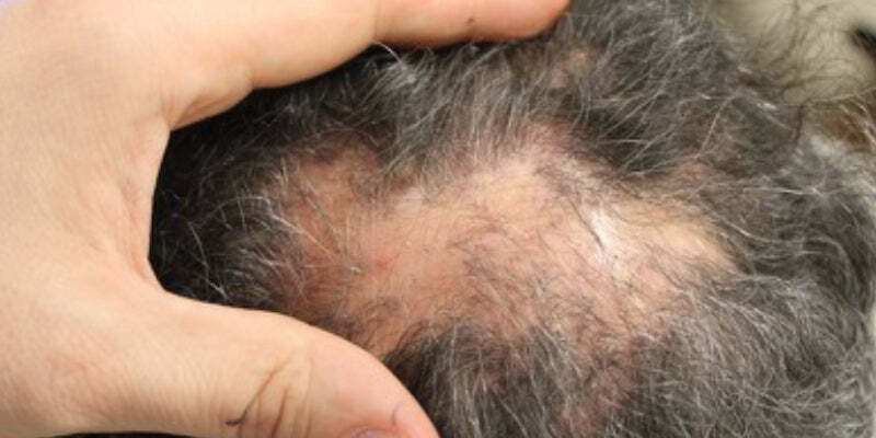 Examination and history taking for hair disorders