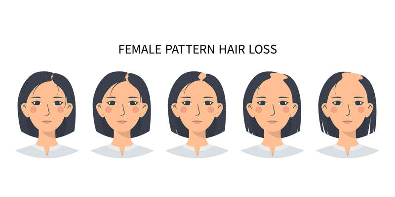Female pattern hair loss - diagnosis and treatment