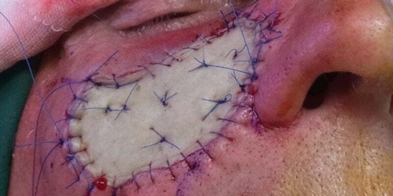 Grafts 