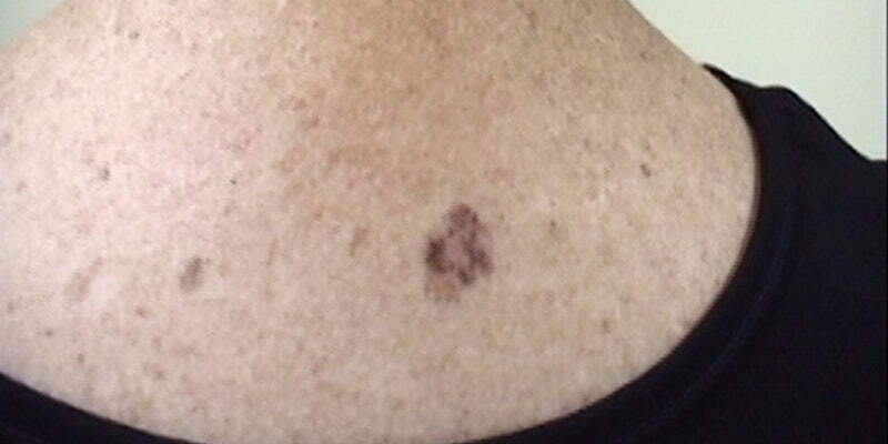 Histopathology of melanocytic lesions Part 1 (Nurses)