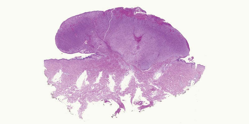 Histopahology of melanocytic lesions Part 2