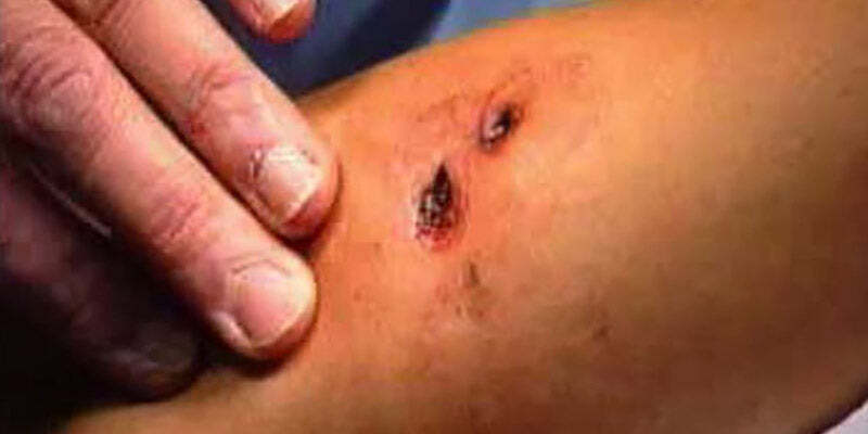 Lacerations and Wounds 