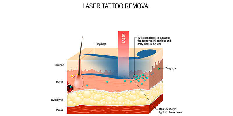 Lasers: Tattoo and Hair Removal