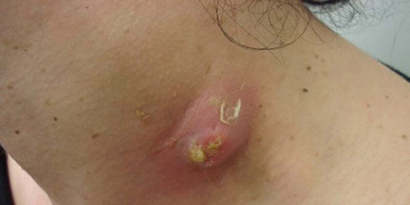 Lumps and Bumps