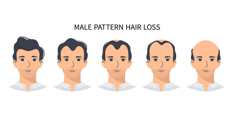 Male pattern hair loss - diagnosis and treatment