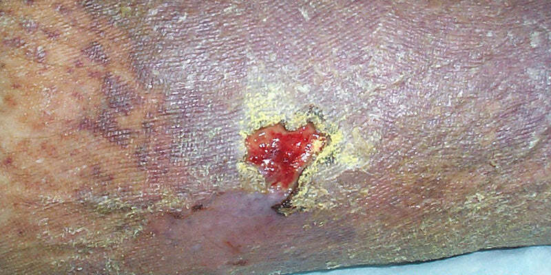 Managing Infected Lesions