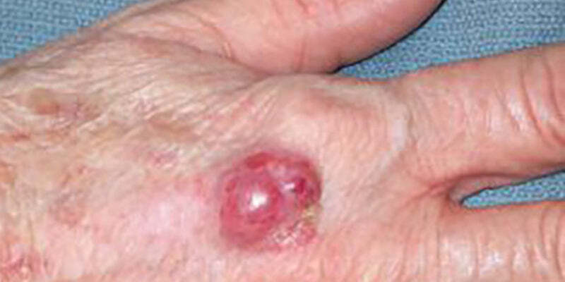 Merkel cell carcinoma and rare/aggressive melanoma and non-melanoma skin cancers (Nurses)