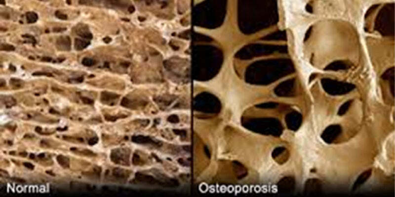 Osteoporosis