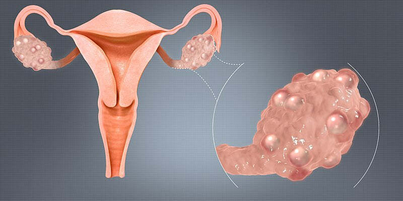 Polyendocrine Metabolic Ovarian Syndrome